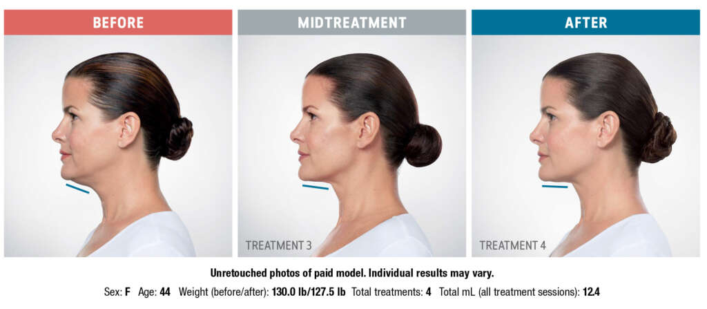 Kybella: A Revolutionary Solution for Double Chins and Beyond