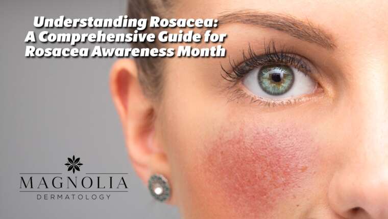 Understanding Rosacea: A Comprehensive Guide for Rosacea Awareness Month