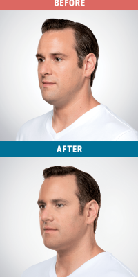 Kybella before and after