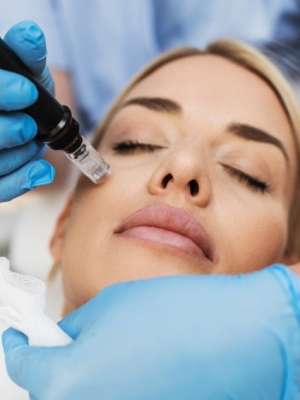 Microneedling in Frisco TX at Magnolia Dermatology